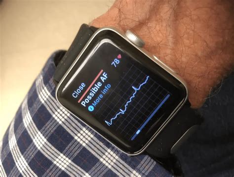 apple watch and kardia ecg